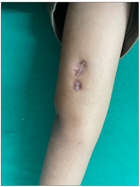 Puckered plaques with crust on the medial aspect of the left lower arm.